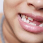 How To Pull A Wisdom Tooth At Home Without Pain
