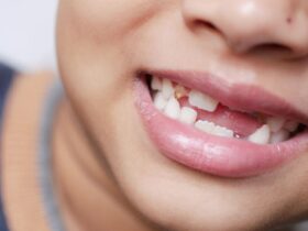 How To Pull A Wisdom Tooth At Home Without Pain