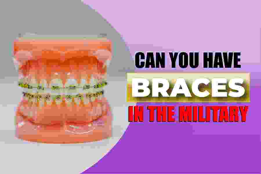 Can You Have Braces in the Military